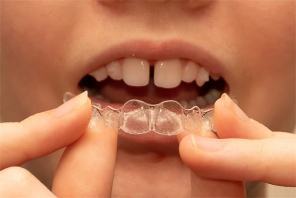Orthodontic Treatment Options: What You Need To Know