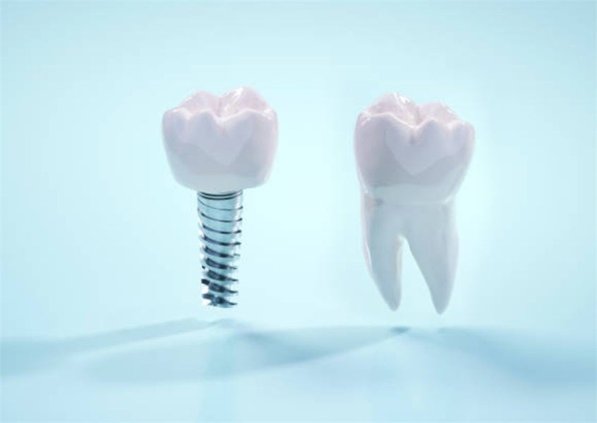 Dental Implants in Hong Kong: Procedures, Costs, and Recovery
