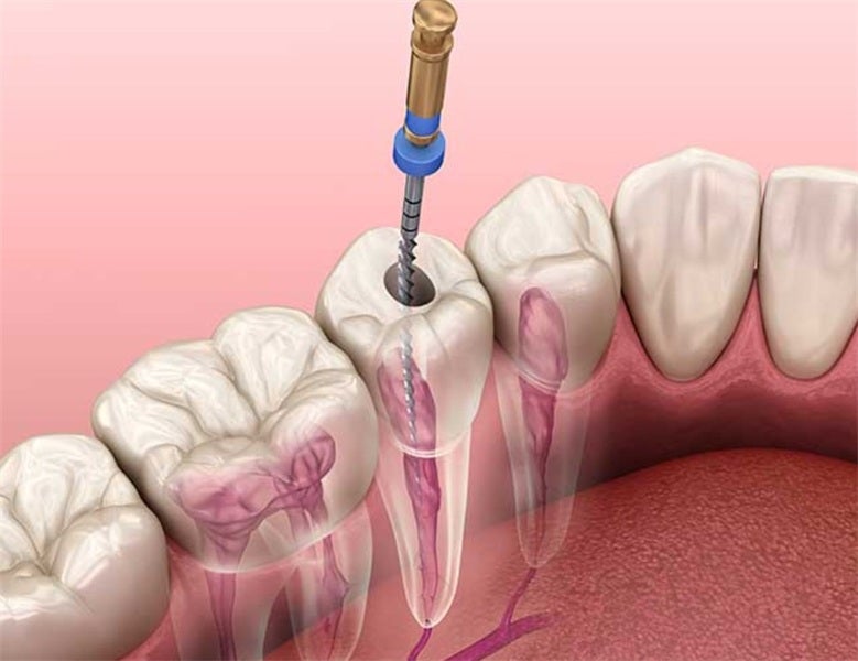 Root Canal or Extraction? Understanding the Costs and Benefits