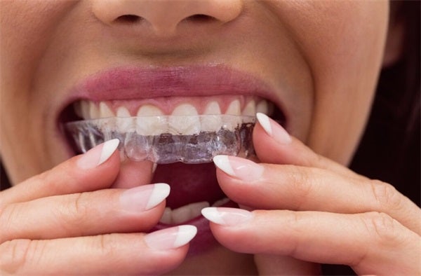 What You Should Know About Invisalign: A Clear Path to a Better Smile