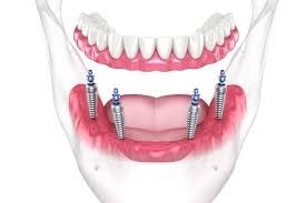 Dental Implants vs Dentures | Cosmetic ...