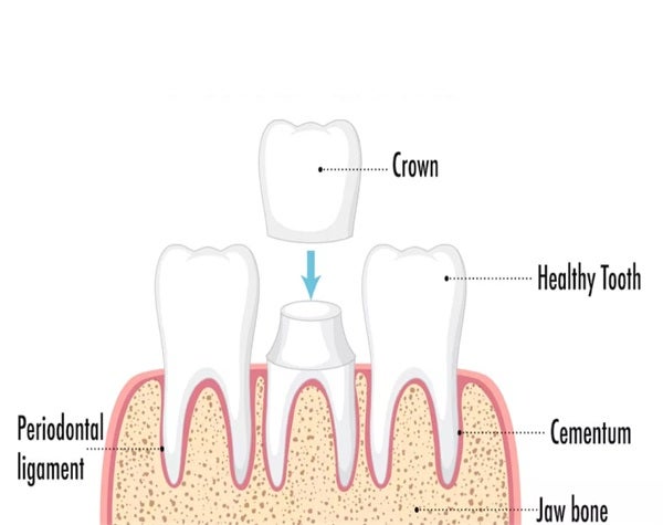 Dental Crowns and Bridges: Restoring Your Smile with Confidence