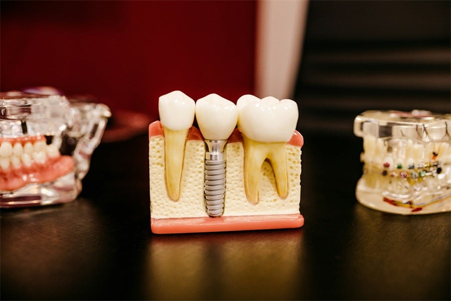 The Reality of Dental Implants in 2025: What UK Patients Actually Experience