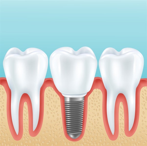 Smile Savers: Navigating the Quest for Affordable Excellence in Dental Implants Therapy