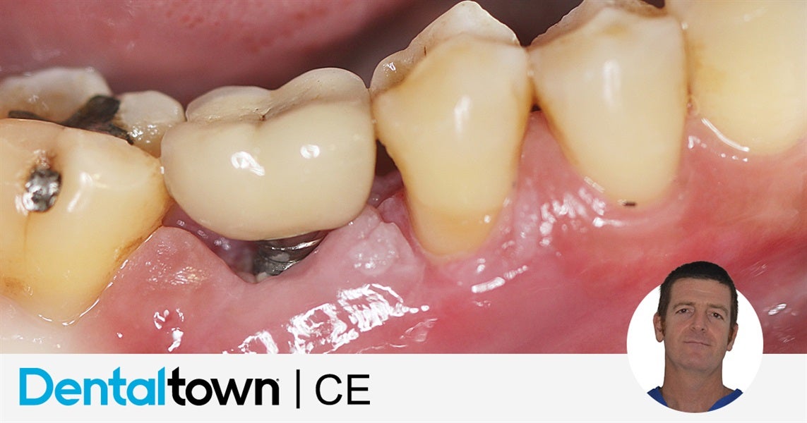 Peri-Impantitis: Its Diagnosis and Management by Dr. Giacomo Tarquini