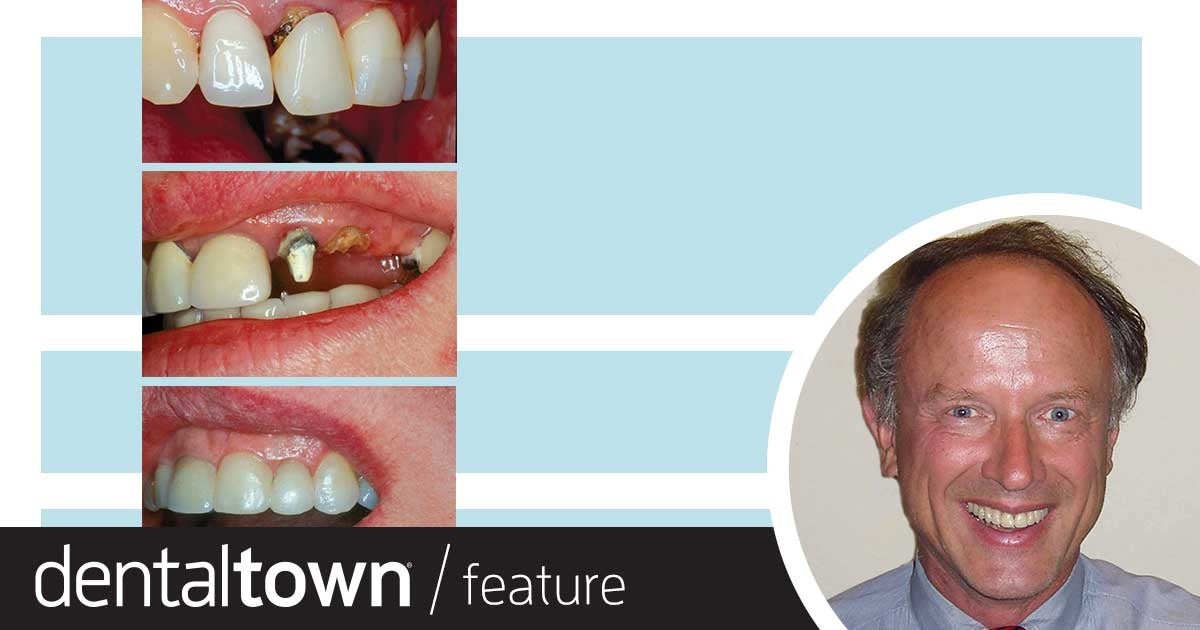 Erupting Compromised Teeth for Restoration