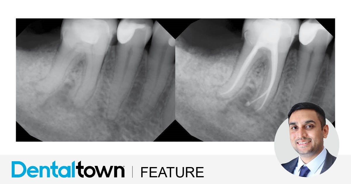 Clinical Case Spotlight: Efficient and Predictable Endodontics