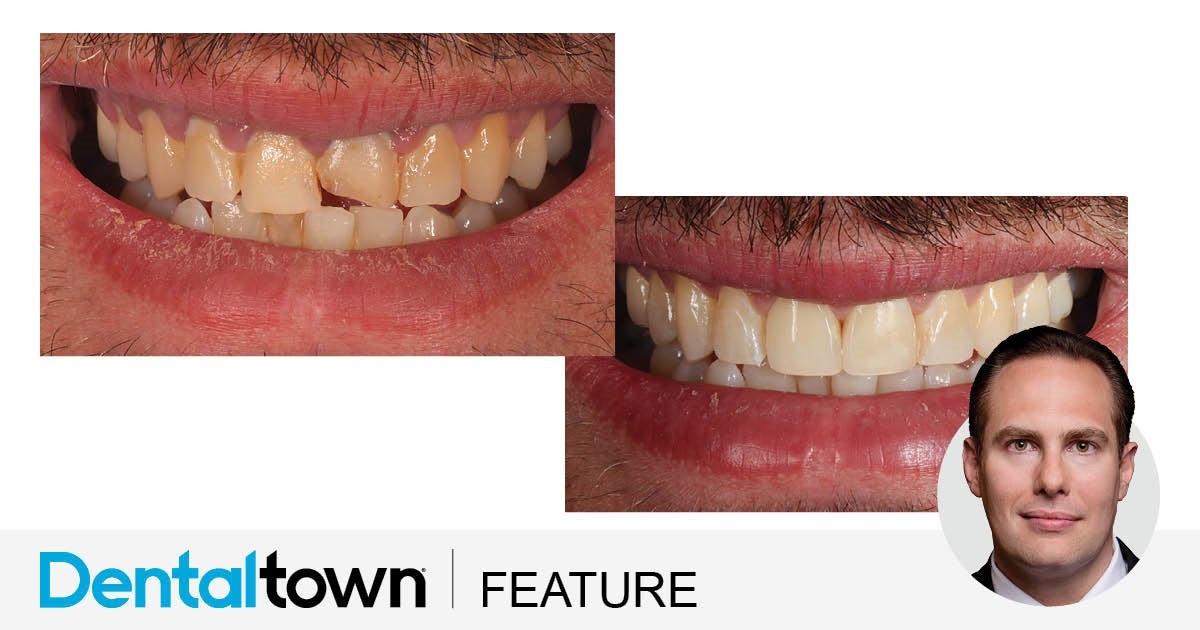 Show Your Work: Full-Contour Veneers and a Fantastic Hygienist