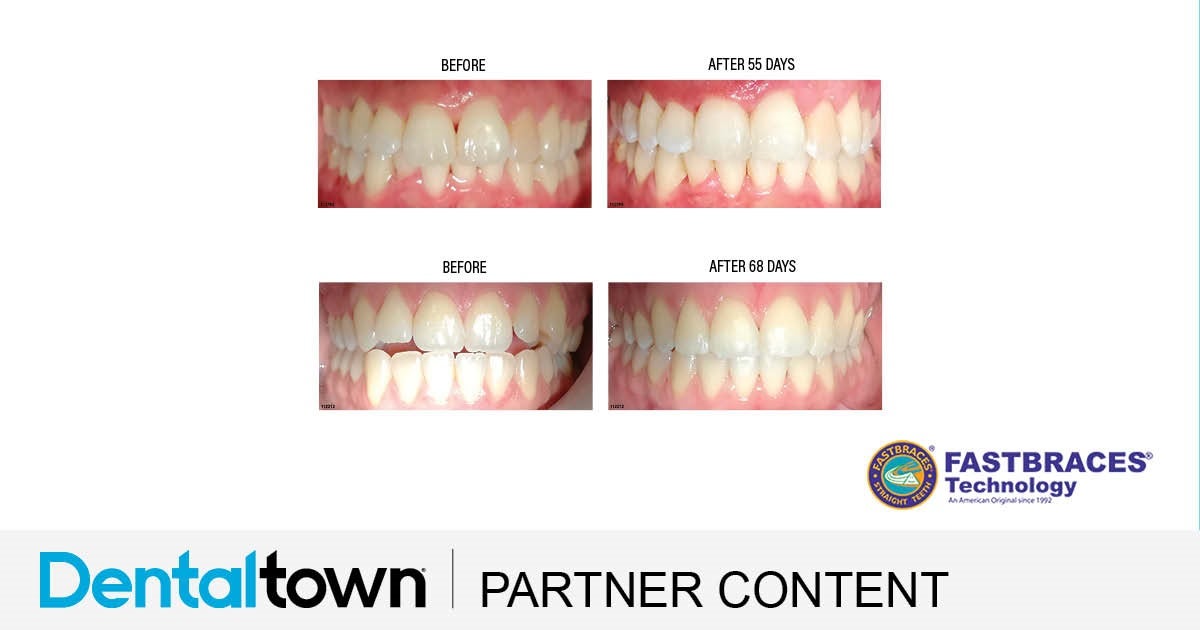 Product Profile: Fastbraces