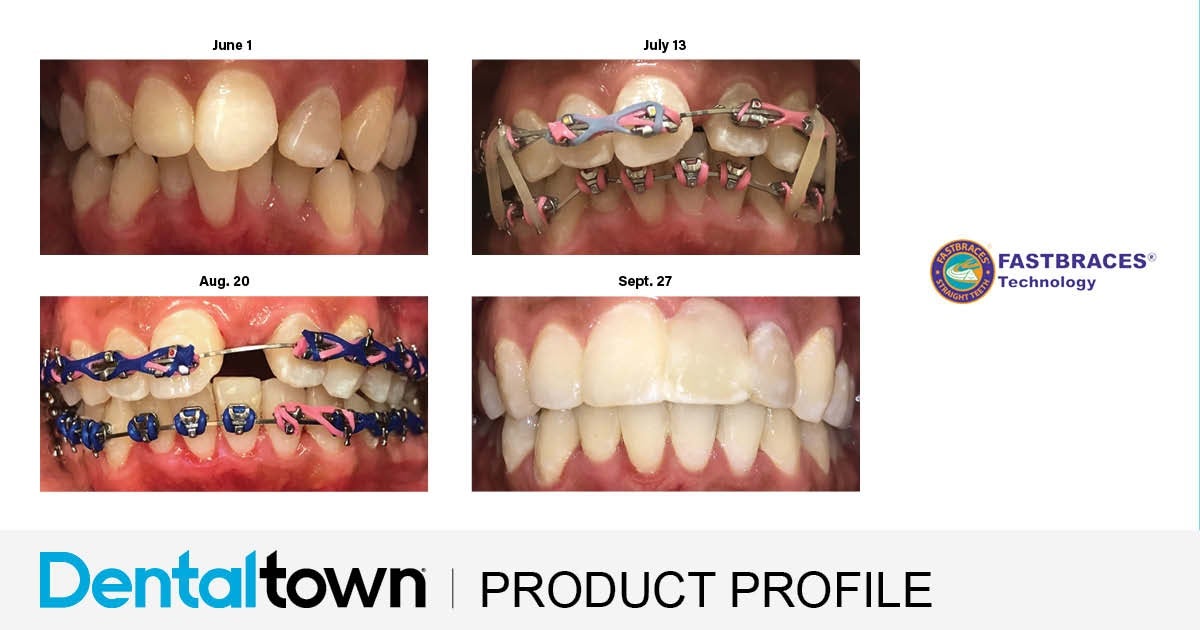 Product Profile: Fastbraces