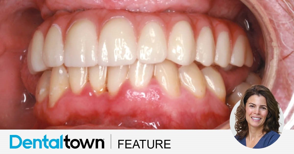 Show Your Work: A Traditional Touch to All-on-X Treatment