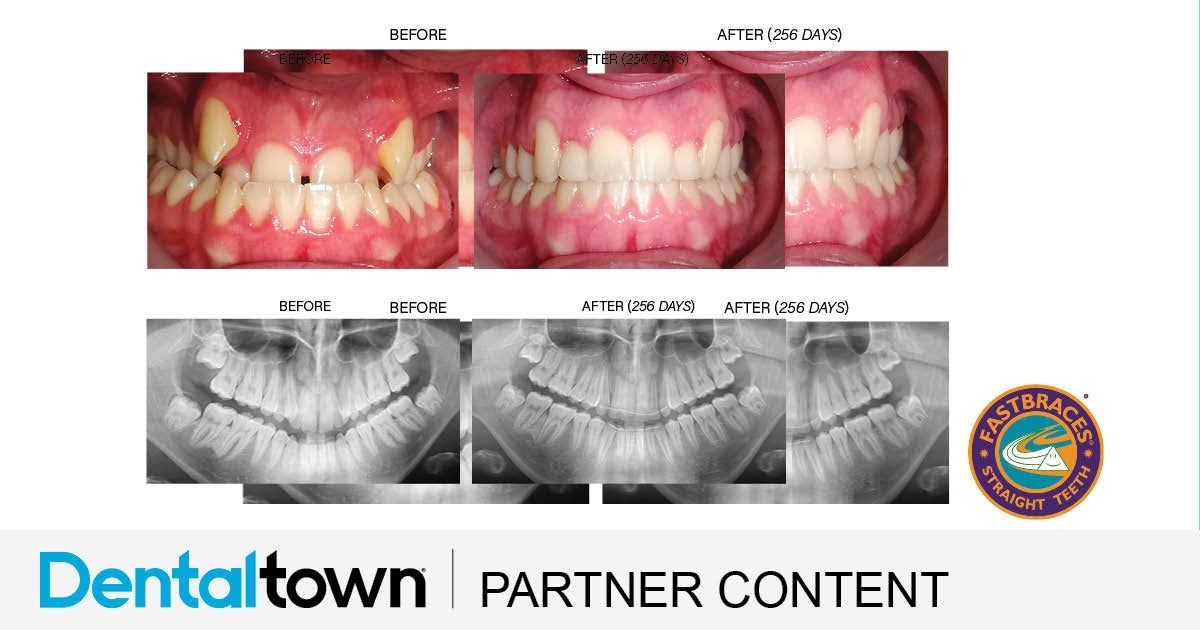 Product Profile: Fastbraces