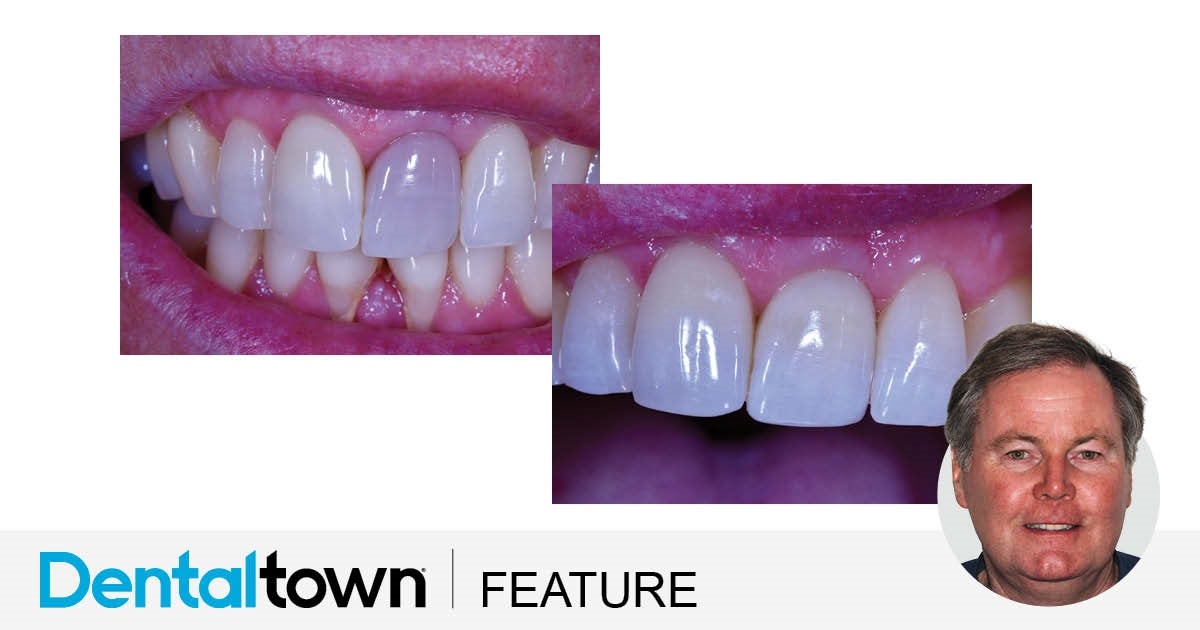 Bleaching Discolored Endodontically Treated Teeth
