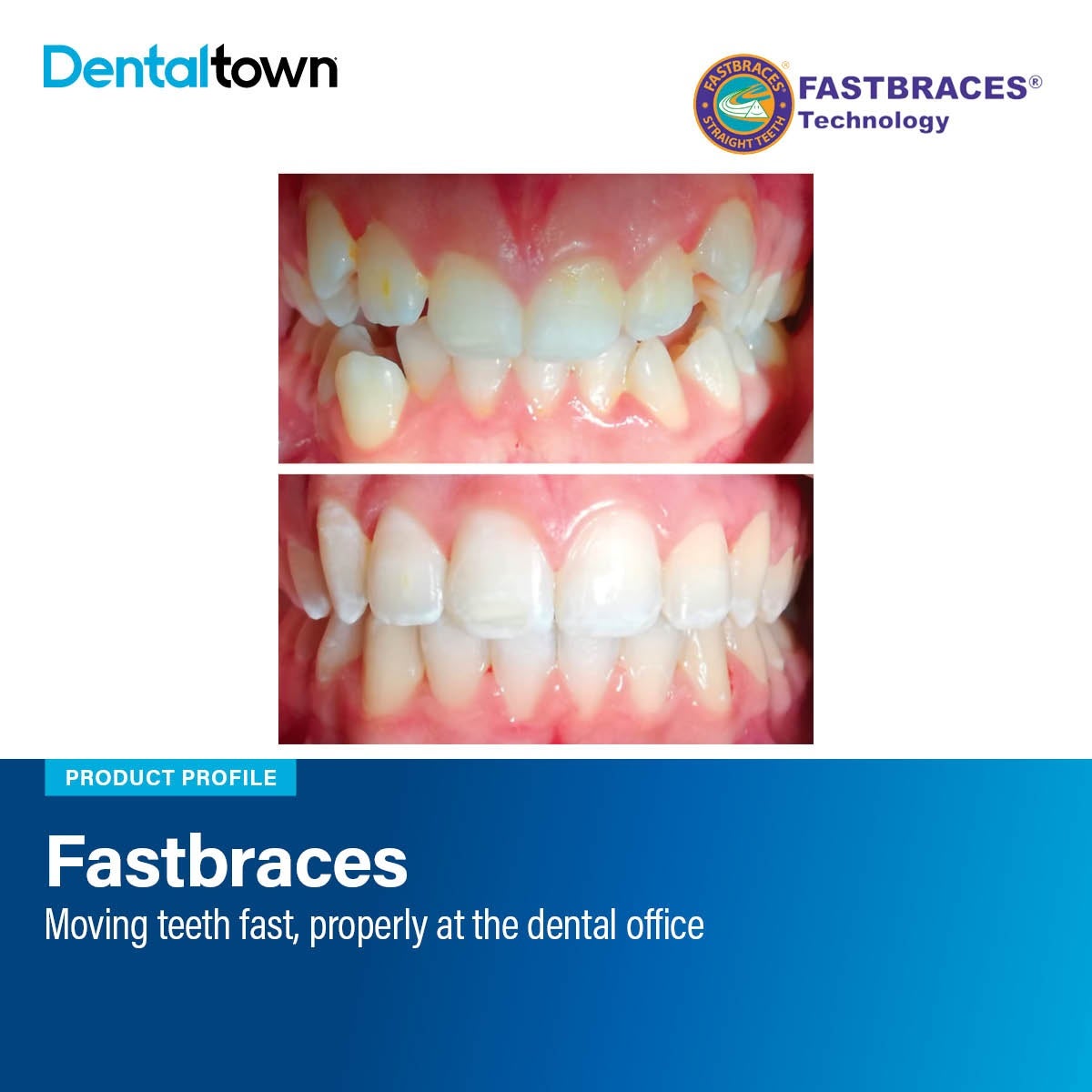 Product Profile: Fastbraces
