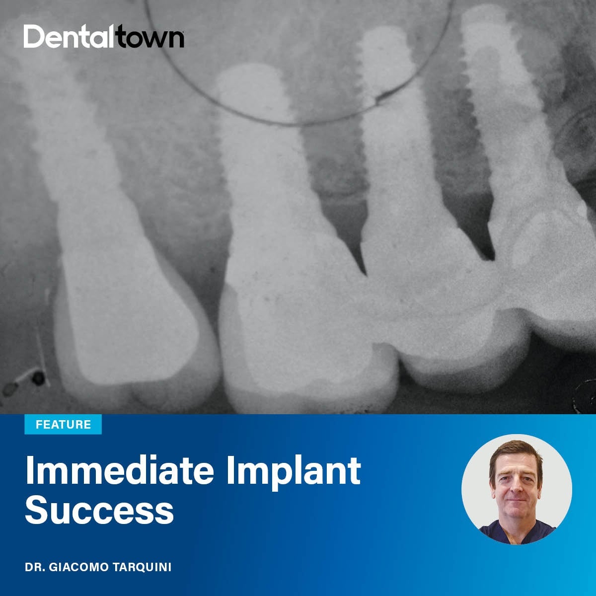 Immediate Implant Success